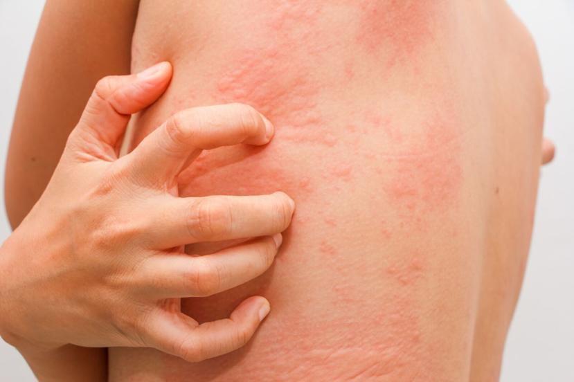 Allergy Treatment